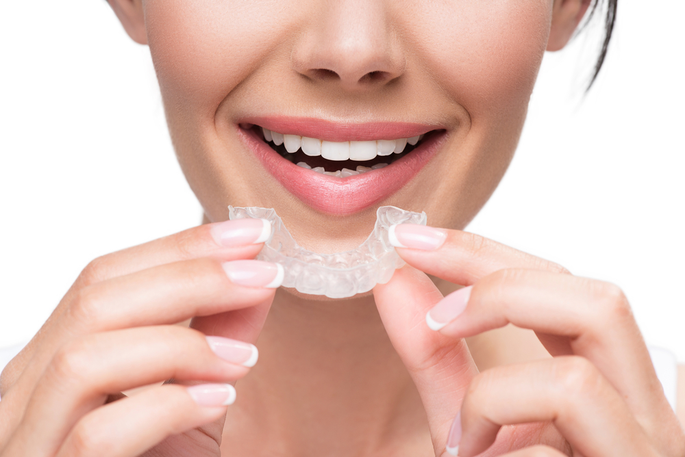 clear aligners