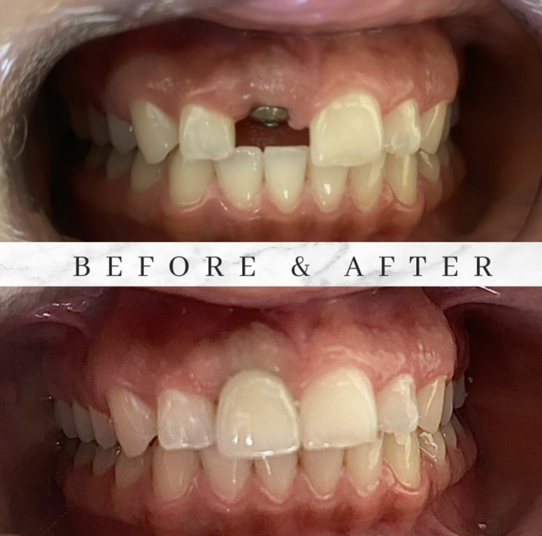 glendale dentist before after photo